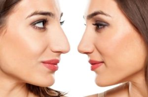Lee más sobre el artículo Qué es la rinoplastia: la cirugía que logra la proporción perfecta entre tu nariz y rostro