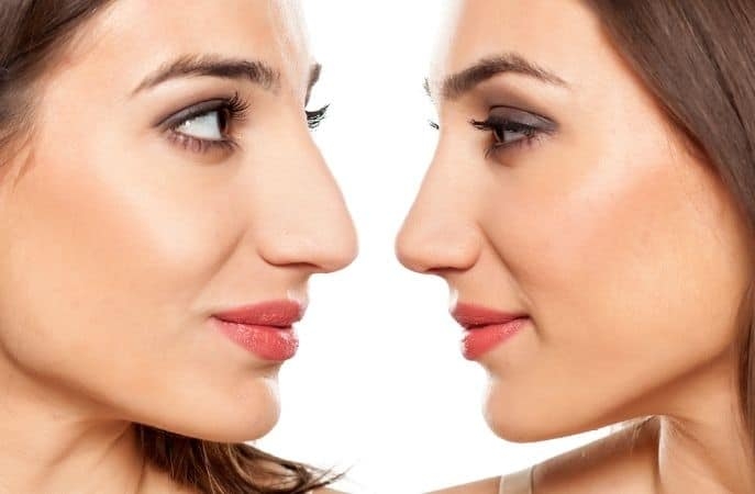 En este momento estás viendo Qué es la rinoplastia: la cirugía que logra la proporción perfecta entre tu nariz y rostro